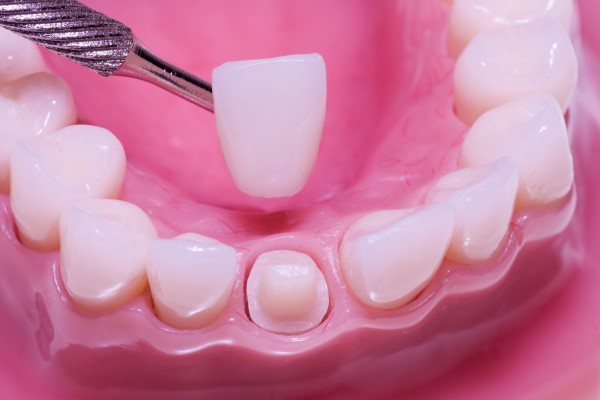 Should You Fix Your Teeth With A Dental Crown Or A Dental Bridge?
