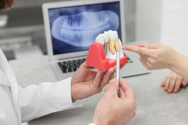 Can Dental Implants Support A Dental Bridge?