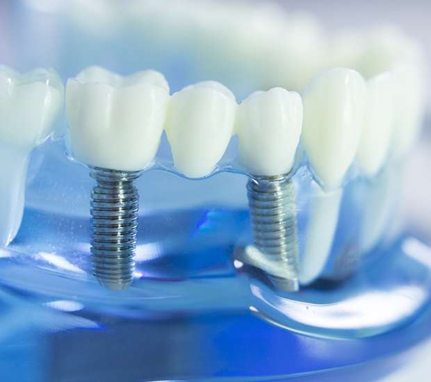 Rome Dental Implants