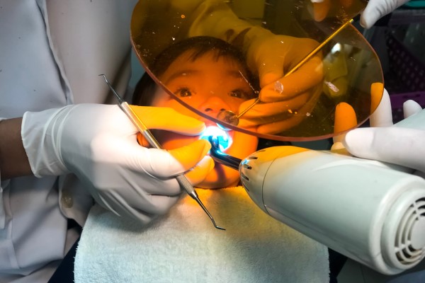 How A Dental Sealant Can Keep Teeth Clean